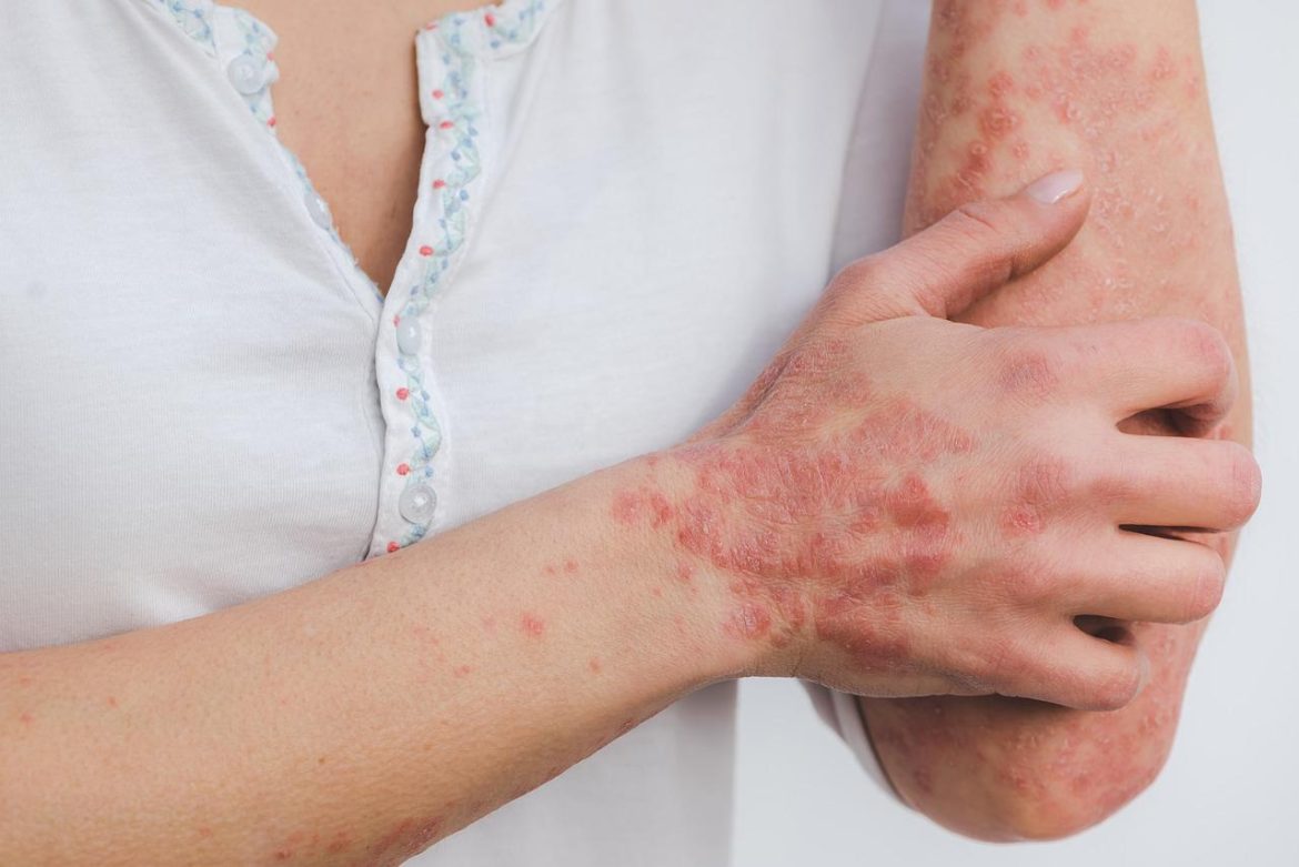 5 conseils pour soigner la peau du psoriasis